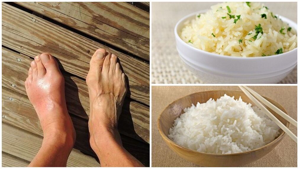 Een dieet op basis van rijst wordt aanbevolen voor jichtpatiënten. 